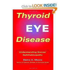  Thyroid Eye Disease Understanding Graves Ophthalmopathy 